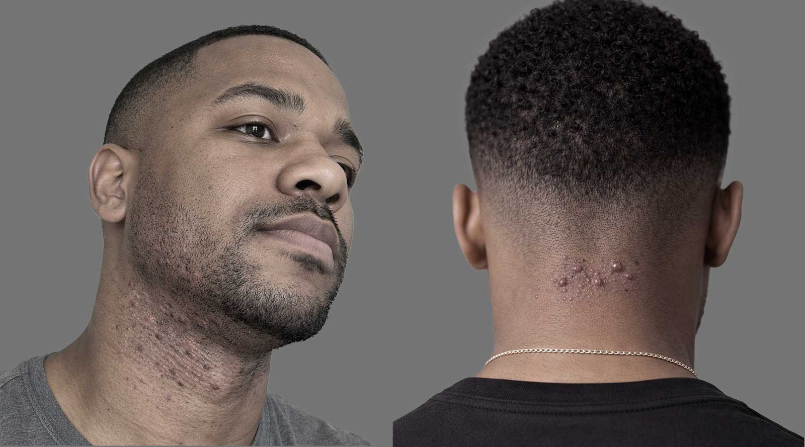 Razor Bumps vs Folliculitis: How to Tell the Difference (and What to Do)