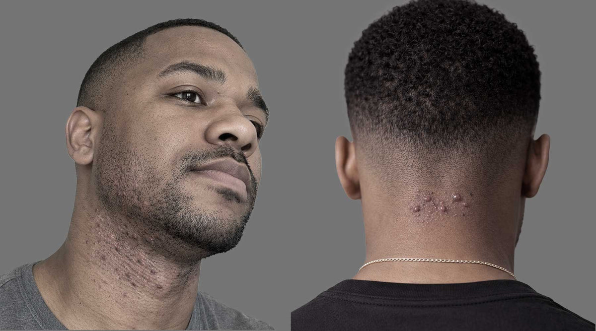 Razor Bumps vs Folliculitis: How to Tell the Difference (and What to D ...